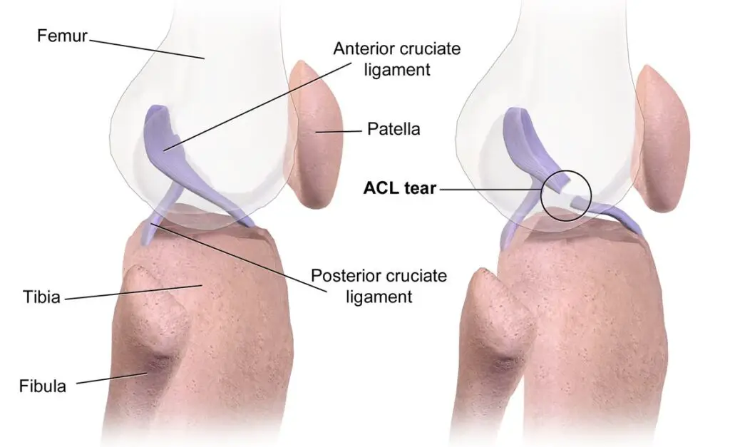 Torn ACL Diagram